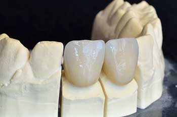 Lahaina Dental Crowns