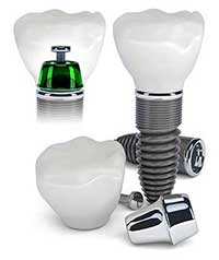Lahaina Dental Implants