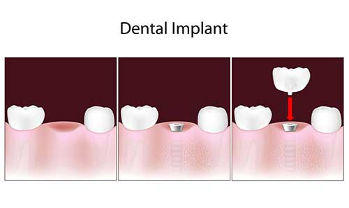 Implant Dentist in Lahaina