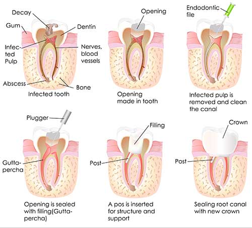 Lahaina Root Canal