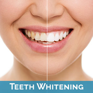 Teeth Whitening near Kaanapali