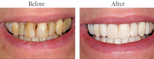 Lahaina Before and After Teeth Whitening