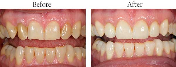 Kapalua Before and After Dental Implants